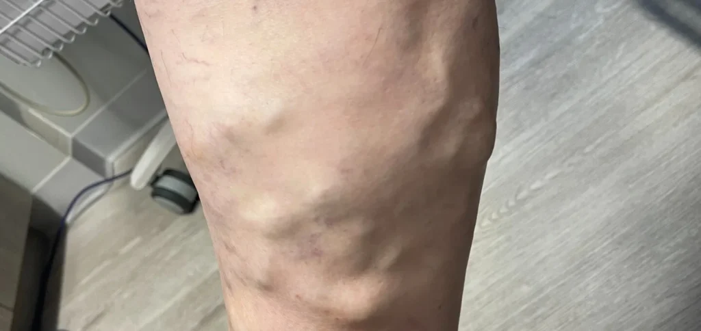 Varicose Vein