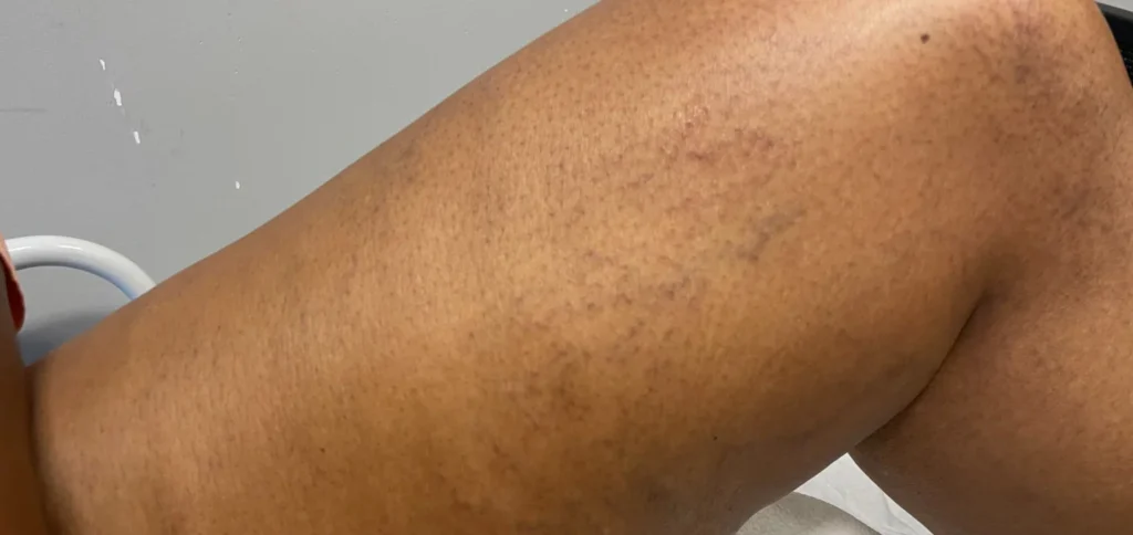 Spider Vein