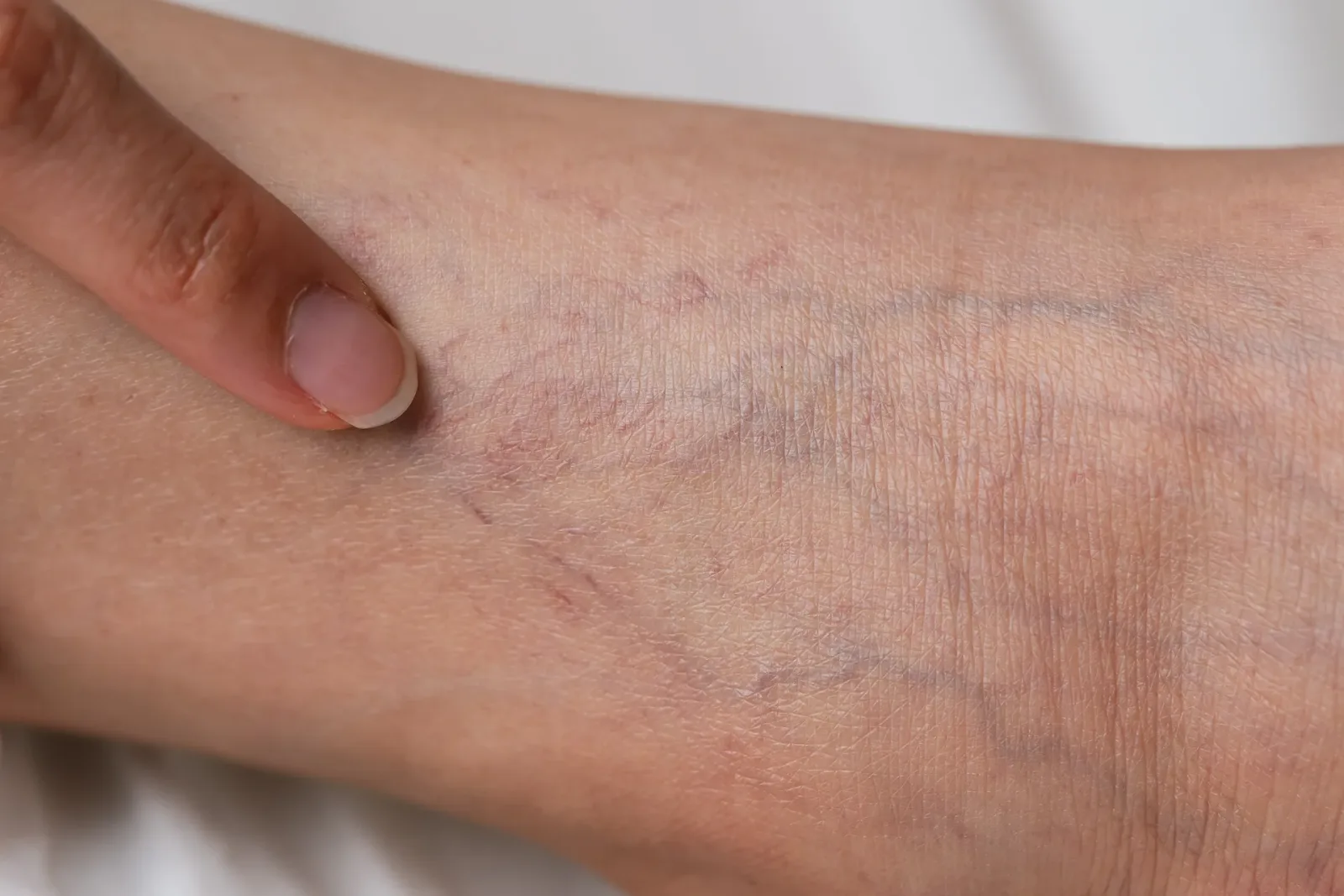 Spider veins on patient's leg