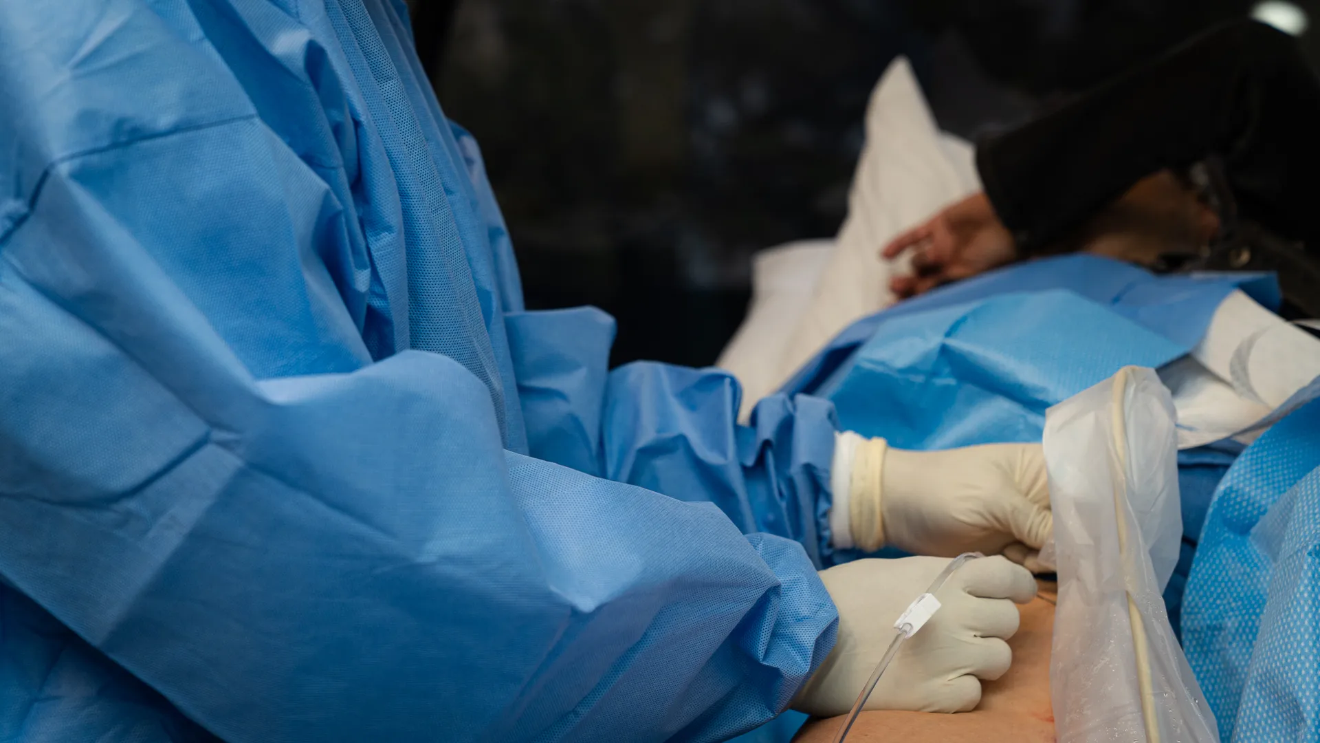 RFA for Varicose Veins